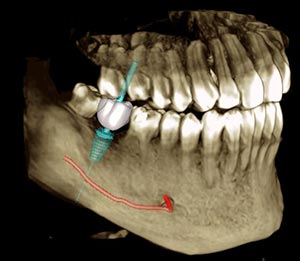 dental implant cone beam
