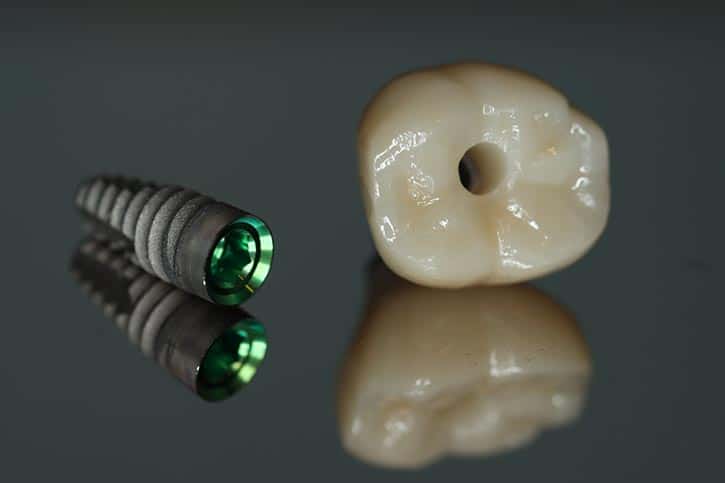 dental implant