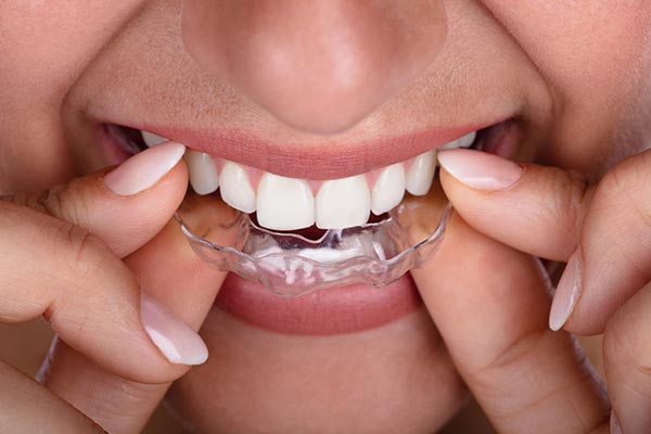 Great Oak Dental Care, Clear Aligners